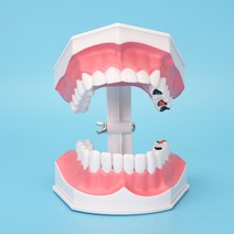 치아모형 인체모형도 치과기구 실리콘몰드 인체모형 어린이 양치교구 재료상, 2배(충치)