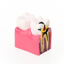 치아 잇몸 모형 치과 실습 강의 교구 어금니 단면 6배, 분홍색