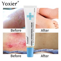 CAICHEN 릴리프 습진 피부염 두드러기 바디크림 허브 건선 항진균성 가려움증 크림, 3개 1개