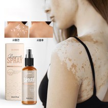 백반증 치료 연고 백반증 커버스프레이 얼굴 피부백반 치료 스프레이, 2개