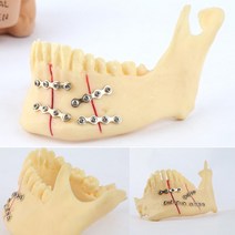 (MX047) 하악 턱뼈 모형뼈골절 부위 스틸장치 인체모형