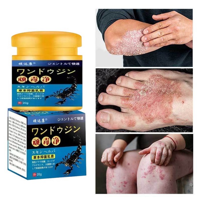 항균소염크림 건선습진붉은피부모기물림 두드러기피부염두피선피부소양증