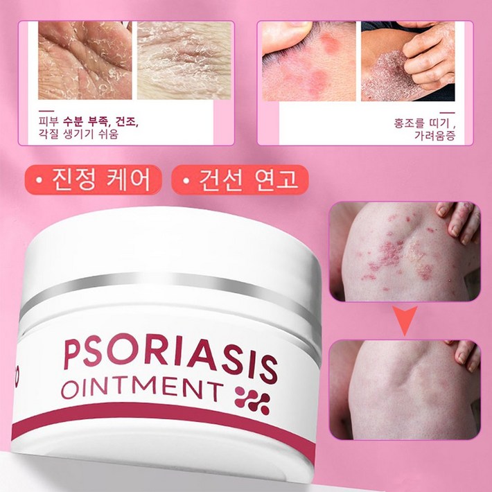 피부가려움증 건선연고 보습크림, 25g, 2개